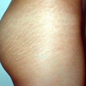 Inicio Prevención-de-las-estrías