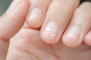 Los problemas de salud de las uñas