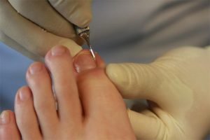 Inicio prevención de las uñas encarnadas